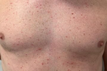 Primer policía diagnosticado con sarna tras haber prestado servicio en la crisis migratoria de Ceuta